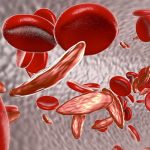 Red blood cells with Sickle Cell Disease