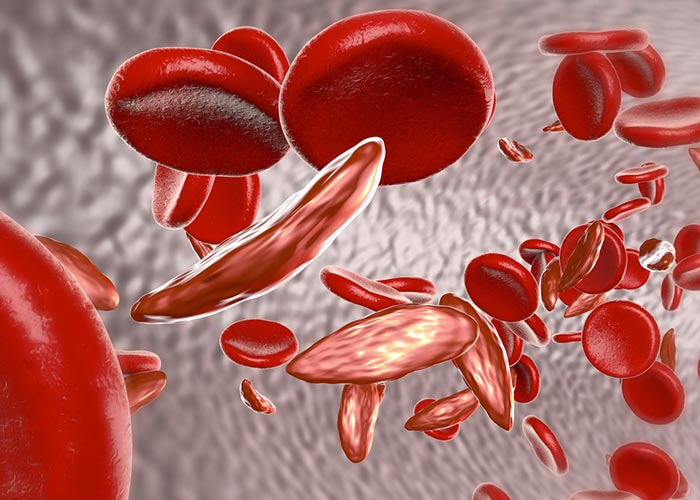 Red blood cells with Sickle Cell Disease