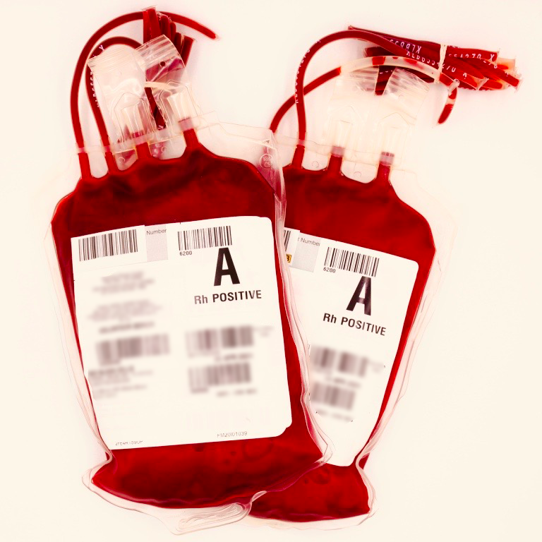 Leukapheresis, Collected By Automated Technology — Stanford Blood Center