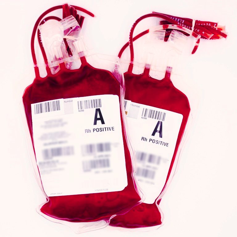 Leukapheresis, Collected By Automated Technology — Stanford Blood Center
